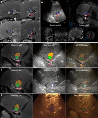 Improving Ablation Safety for Hepatocellular Carcinoma Proximal to the Hilar Bile Ducts by Ultrasound-MR Fusion Imaging: A Preliminary Comparative Study